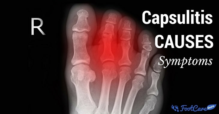 Capsulitis Of The Second Toe Capsulitis Of The Second Toe