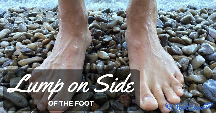 Lump On The Side Of The Foot Lump On The Side Of The Foot