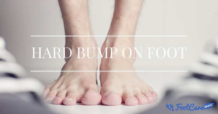 what-is-the-cause-of-the-hard-bump-on-top-of-the-foot-how-to-treat-it