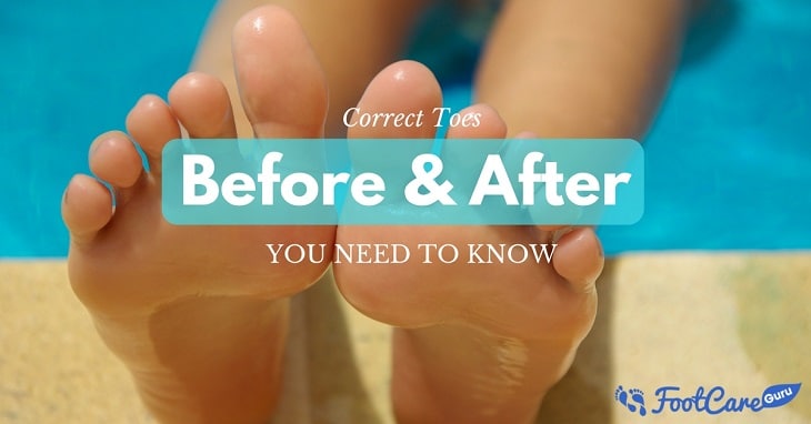 Why Do You Need To Know About Correct Toes Before And After Conditions ...