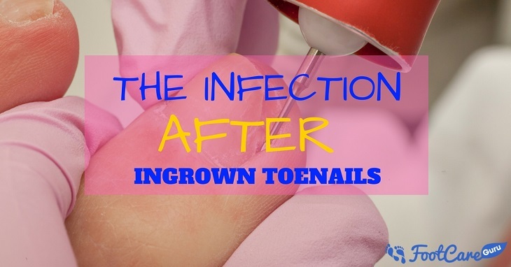 Infection After Ingrown Toenail