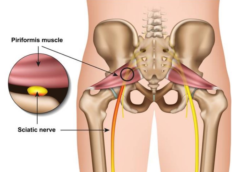 Sciatic Nerve Causes