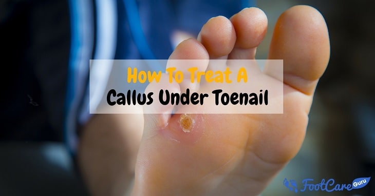 Treat A Callus Under Toenail