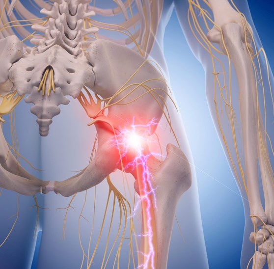 sciatica pain