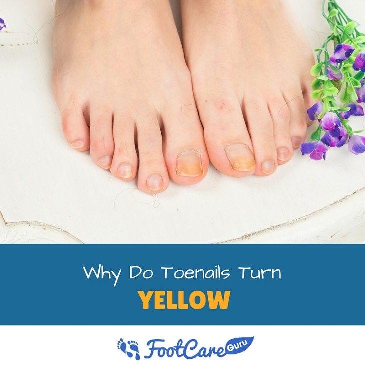 why-do-toenails-turn-yellow-healthier-land