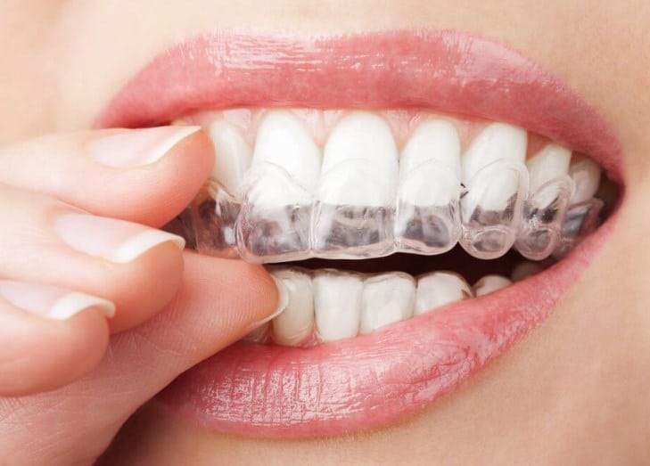 Invisalign teeth