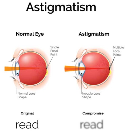 Astigmatism