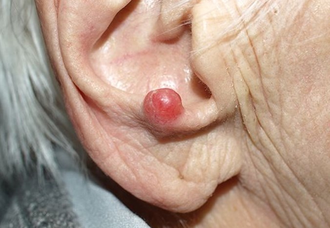 Merkel cell carcinoma 