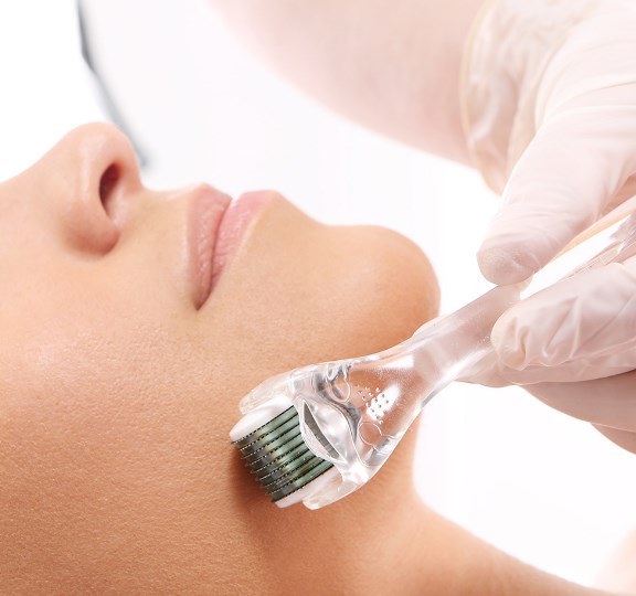 Microneedling