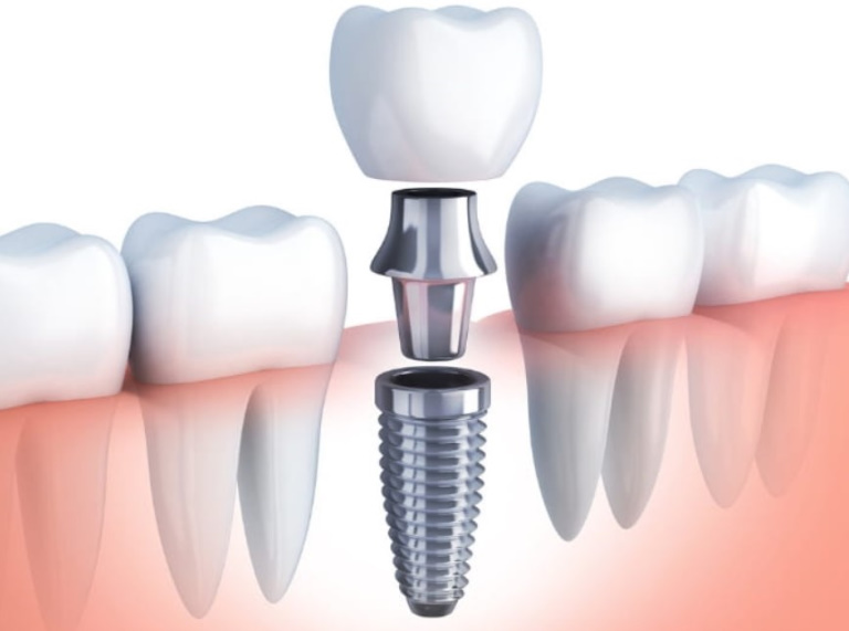 Dental Implants image