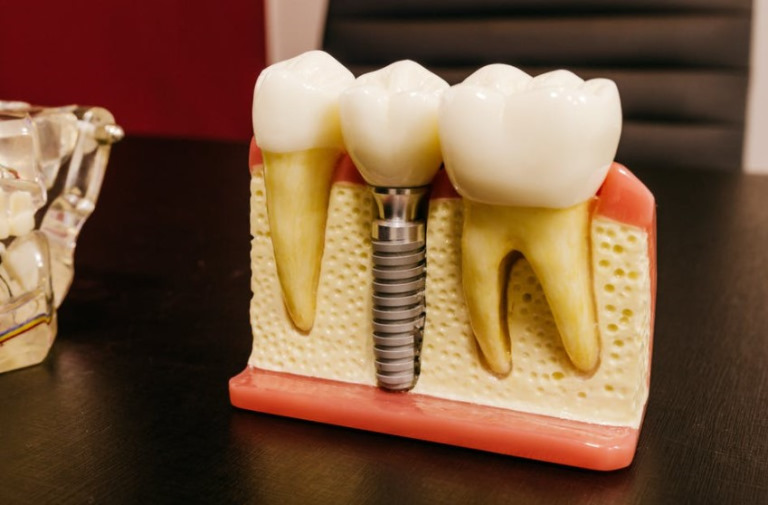 Dental Implants