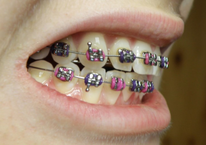 dental braces